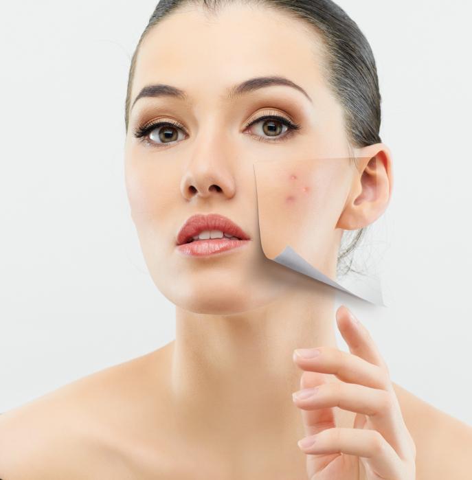 Cómo quitar manchas de acné con agua oxigenada - Belleza estética